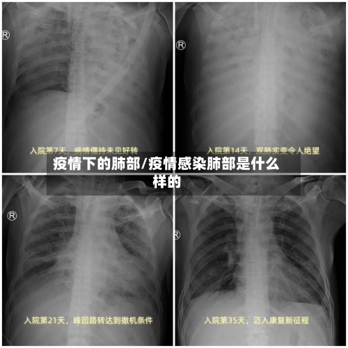 疫情下的肺部/疫情感染肺部是什么样的